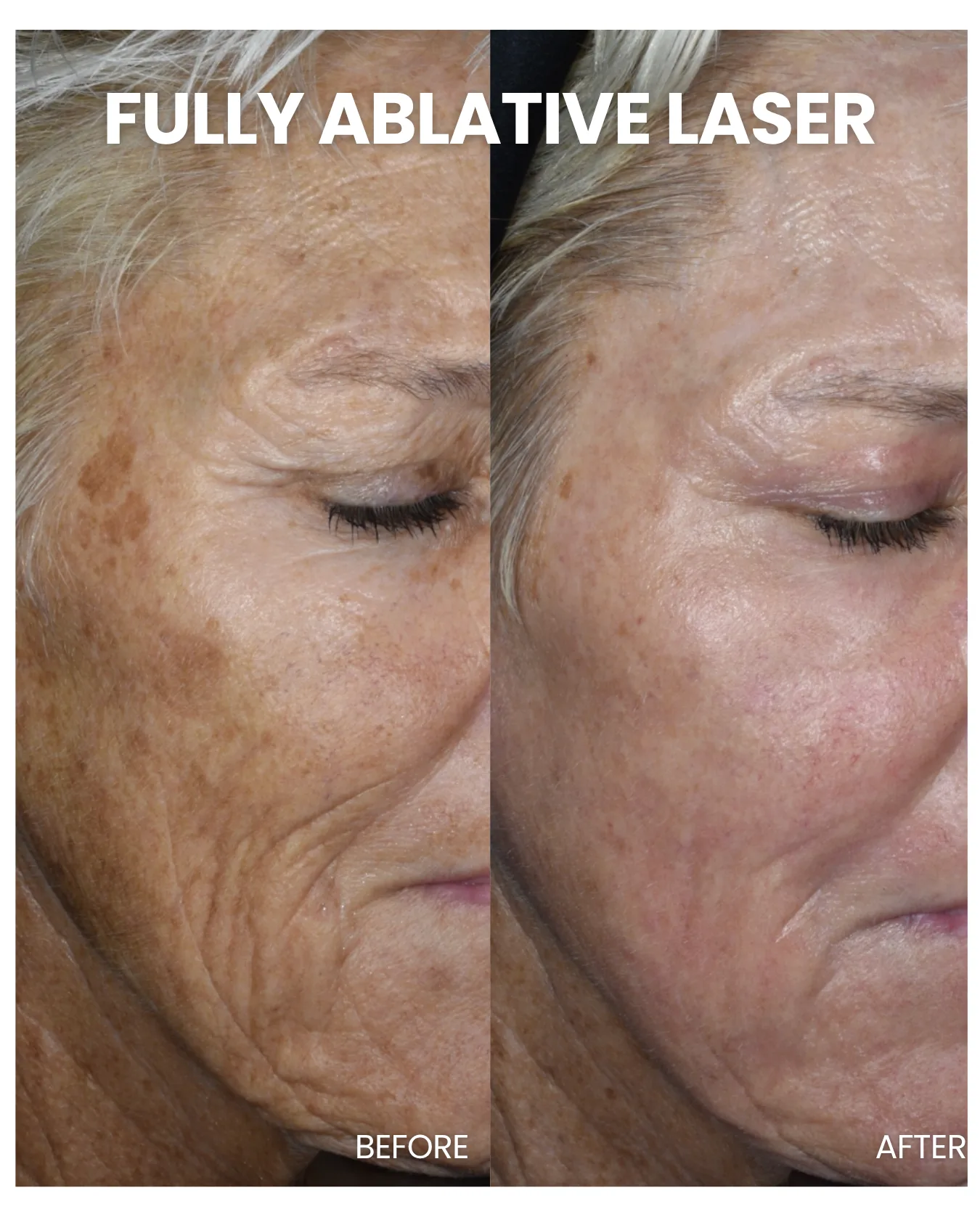 Fully Ablative Laser before and after results