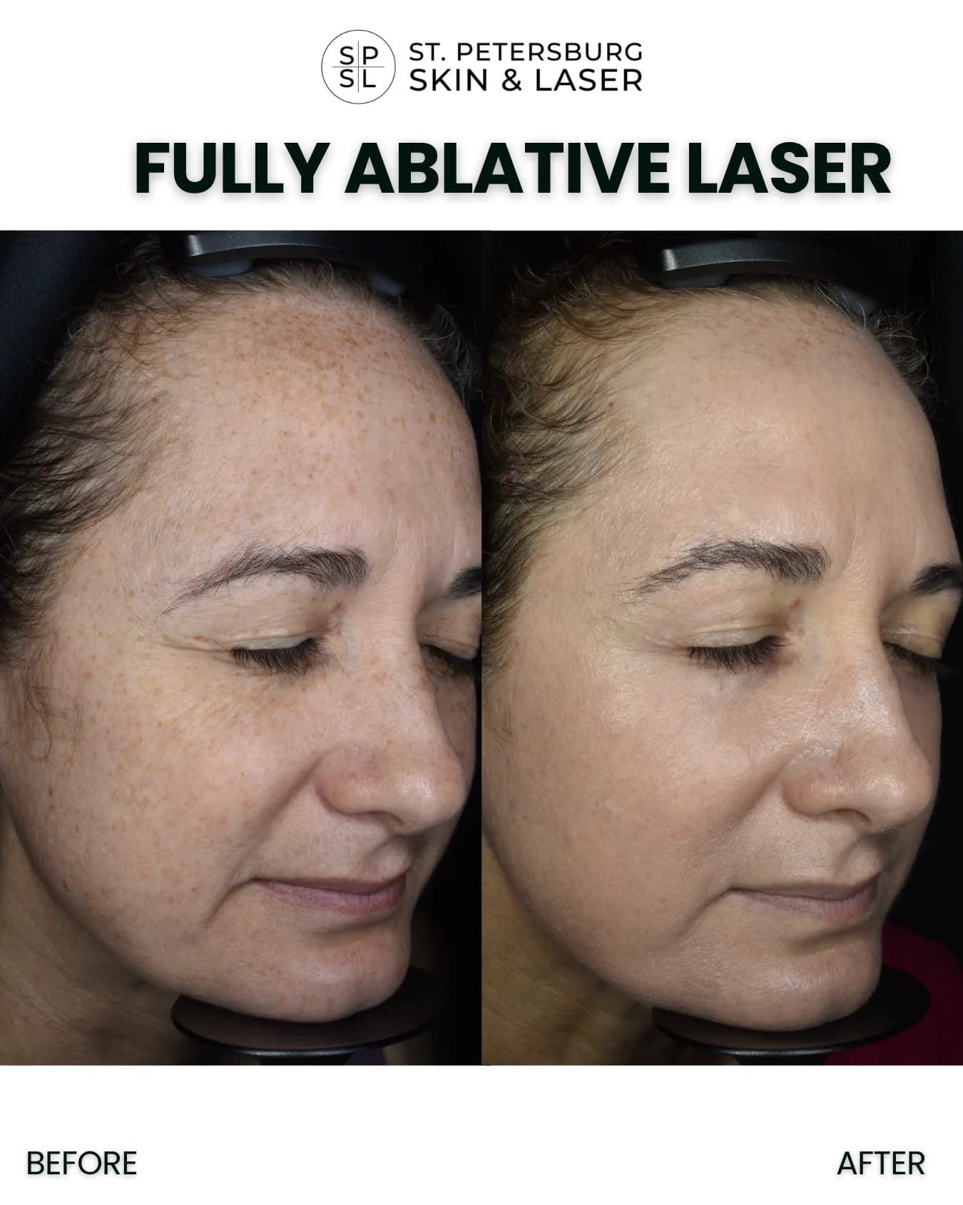 Fully Ablative Laser before and after results
