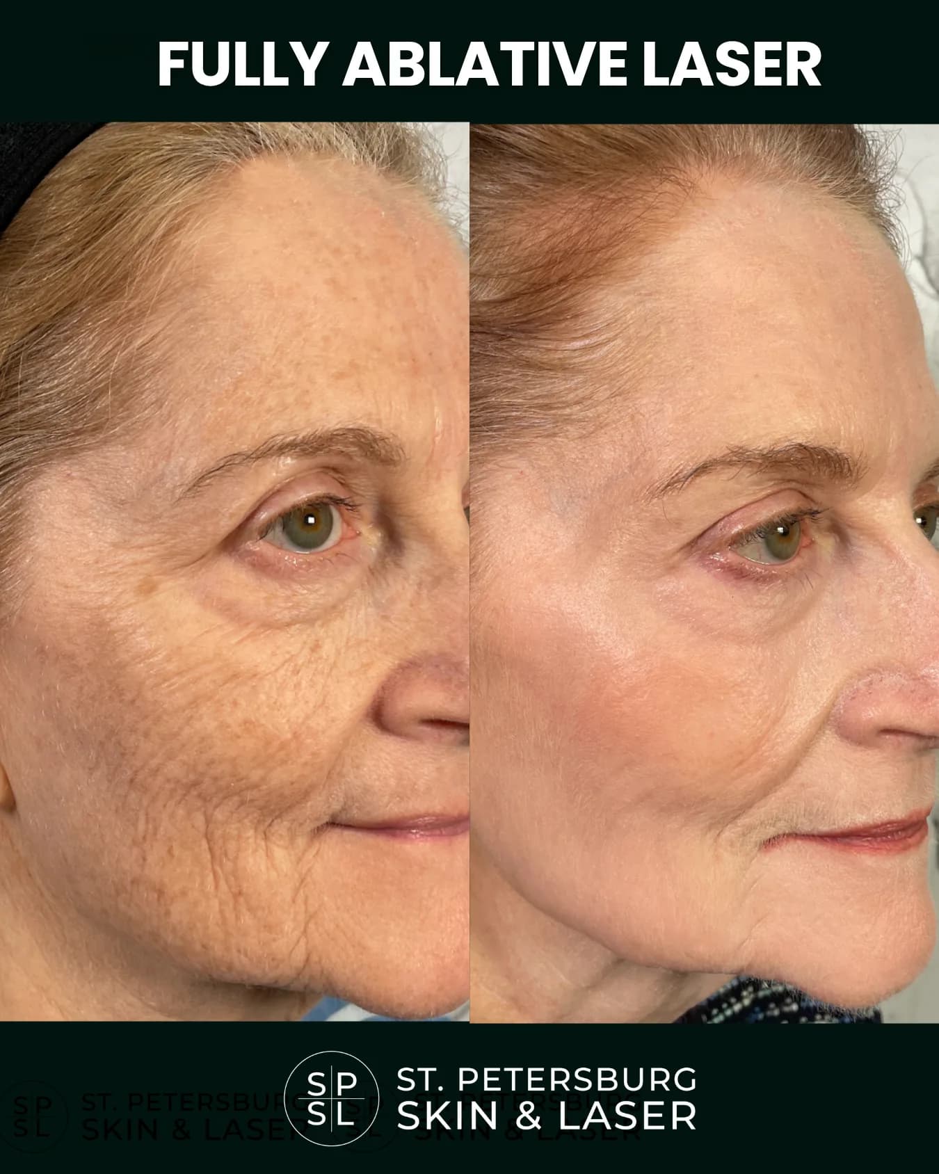 Fully Ablative Laser before and after results