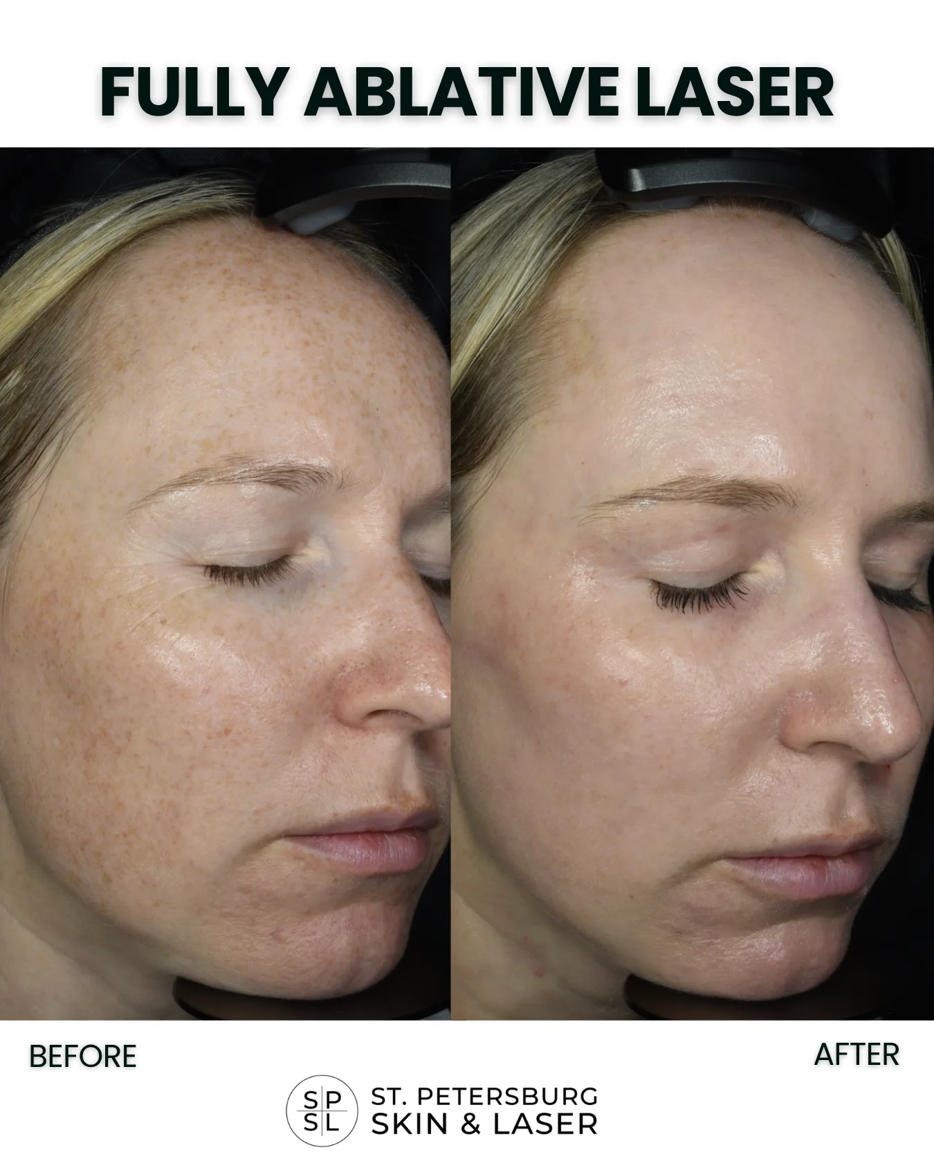 Fully Ablative Laser before and after results