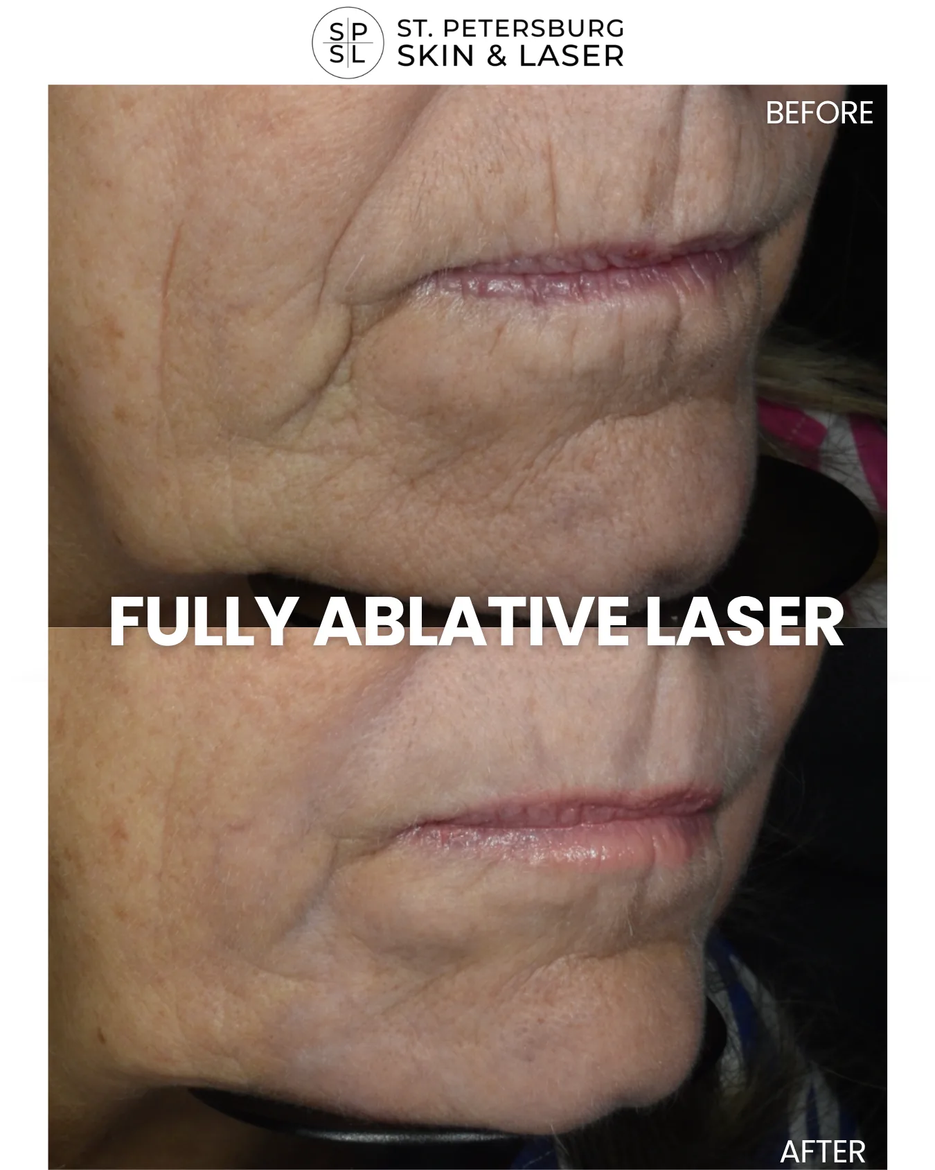Fully Ablative Laser before and after results