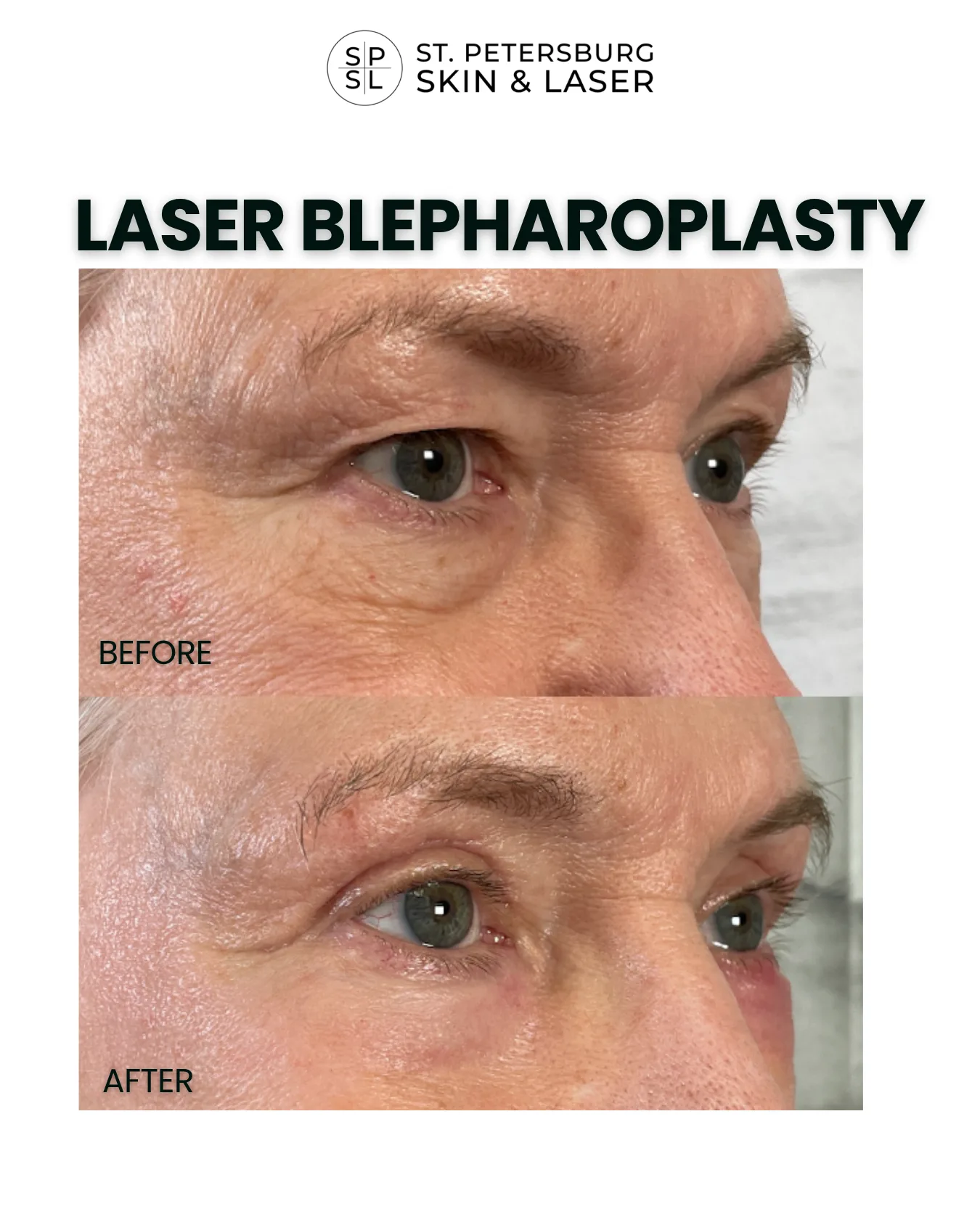 Laser Blepharoplasty before and after results