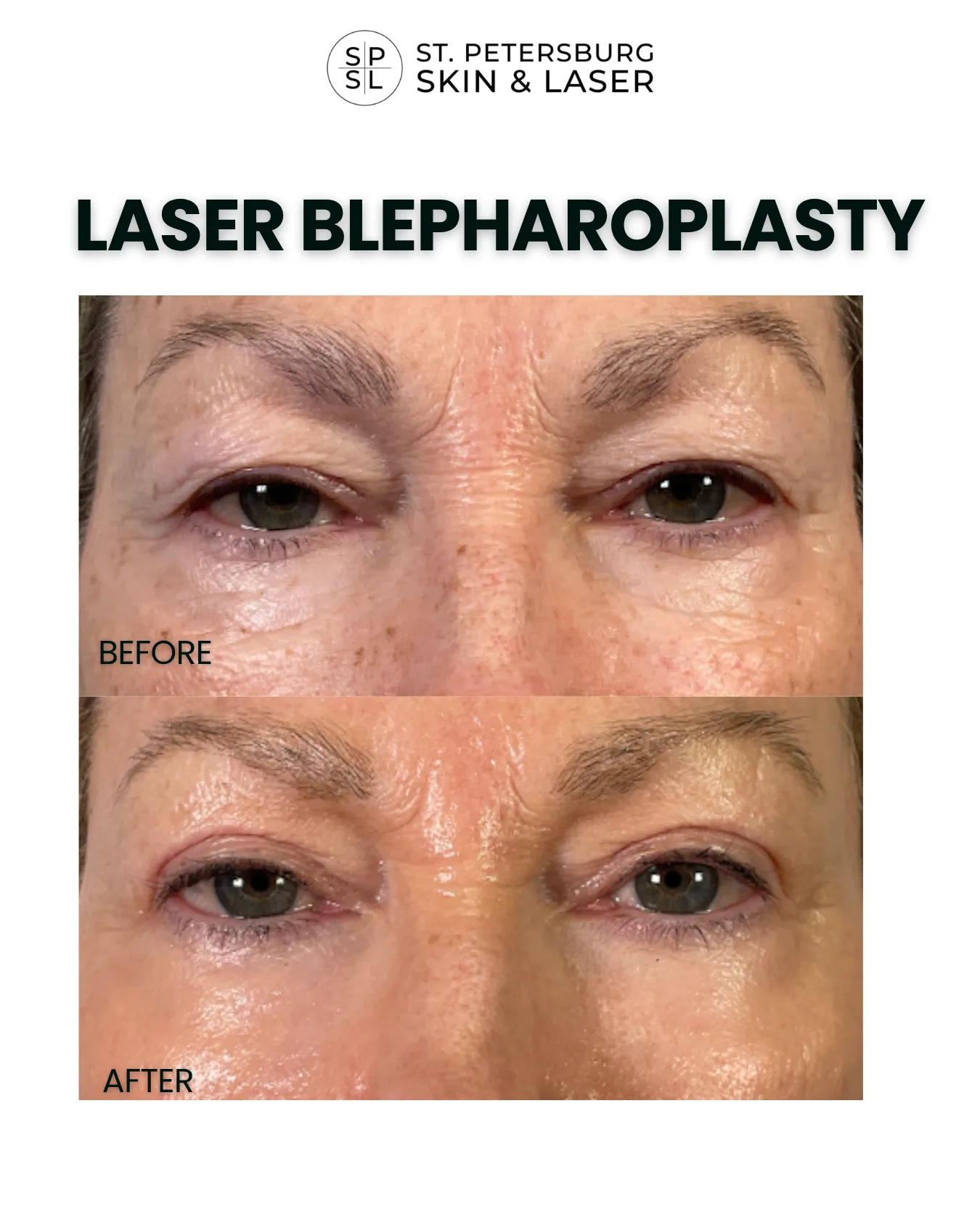 Laser Blepharoplasty before and after results