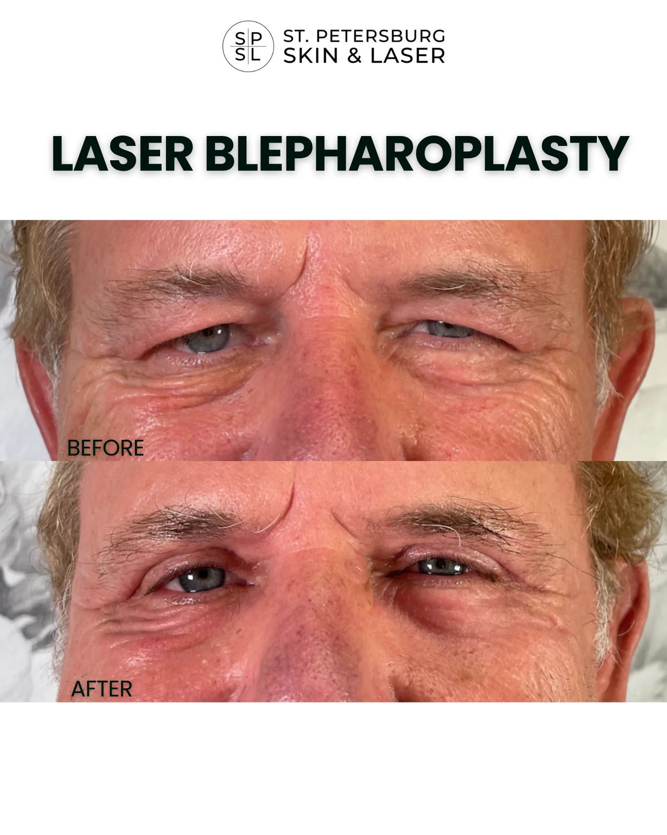 Laser Blepharoplasty before and after results