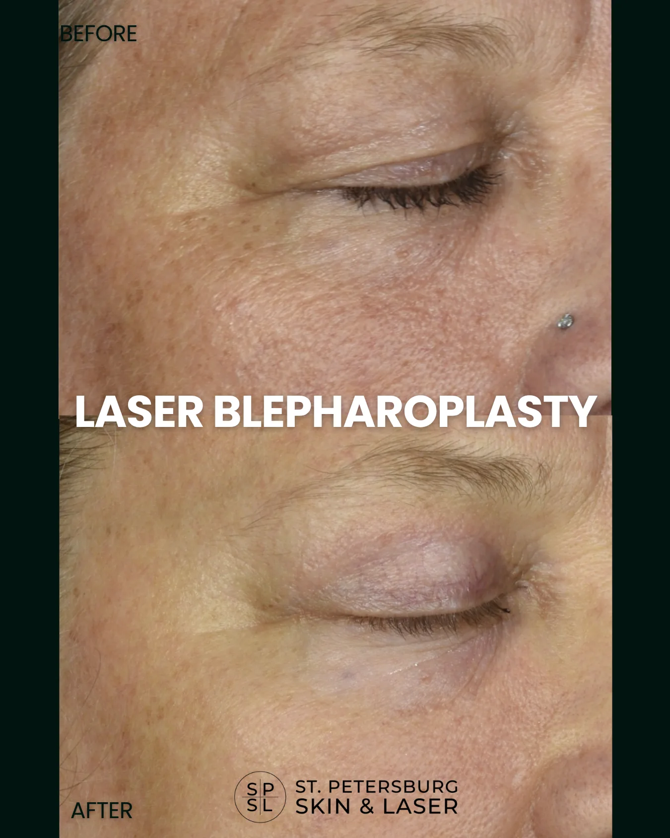 Laser Blepharoplasty before and after results