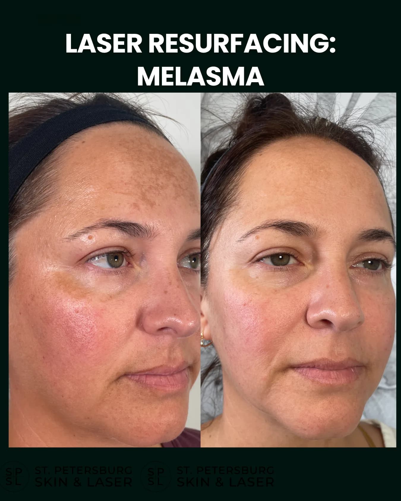 Laser Resurfacing before and after results