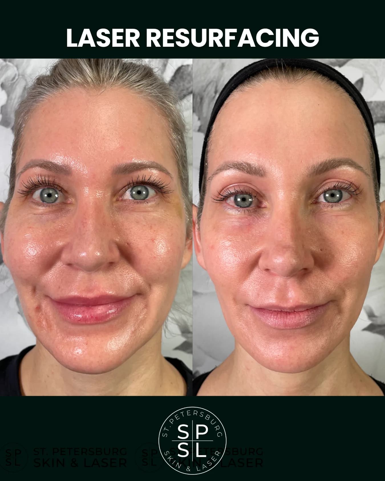 Laser Resurfacing before and after results