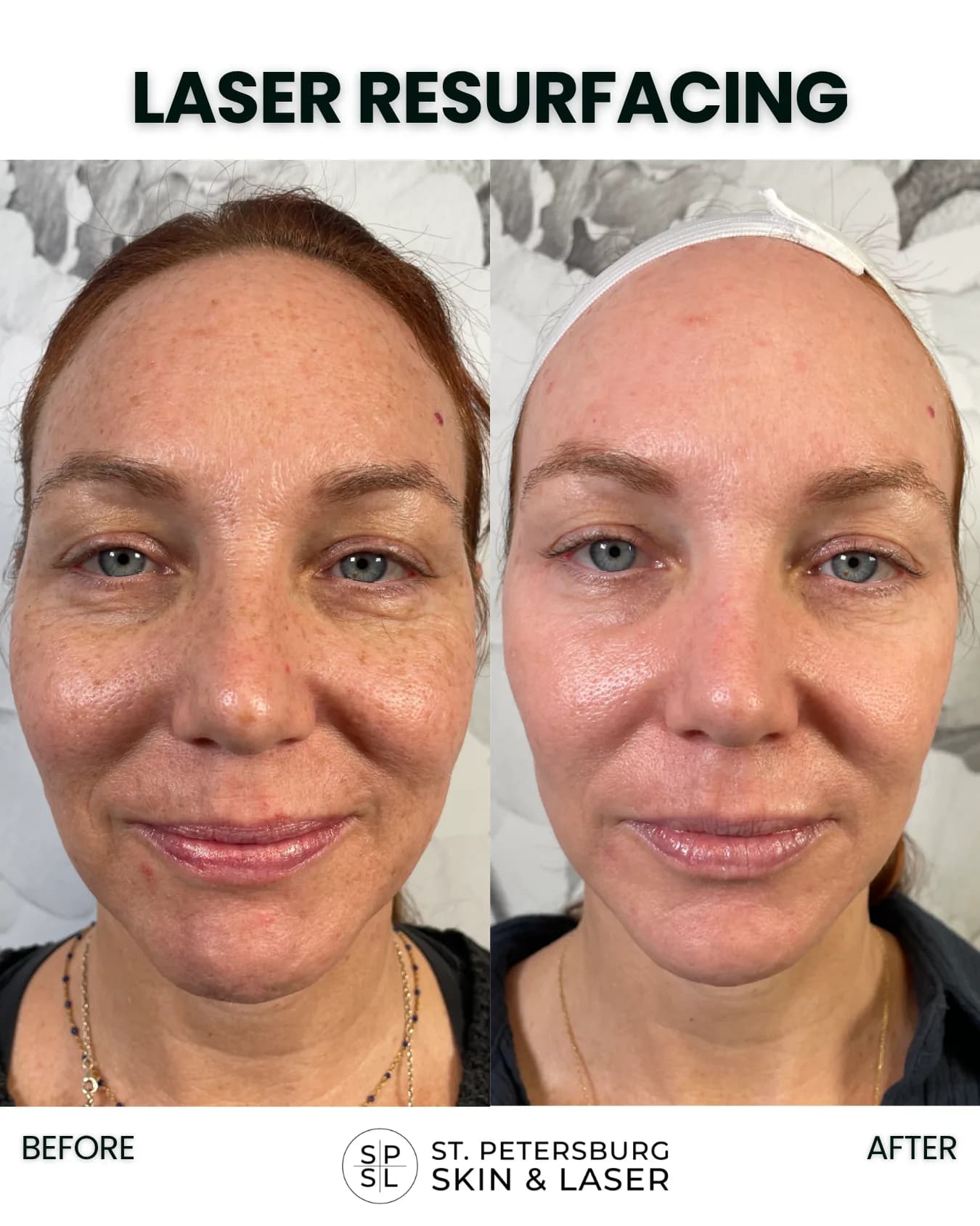 Laser Resurfacing before and after results