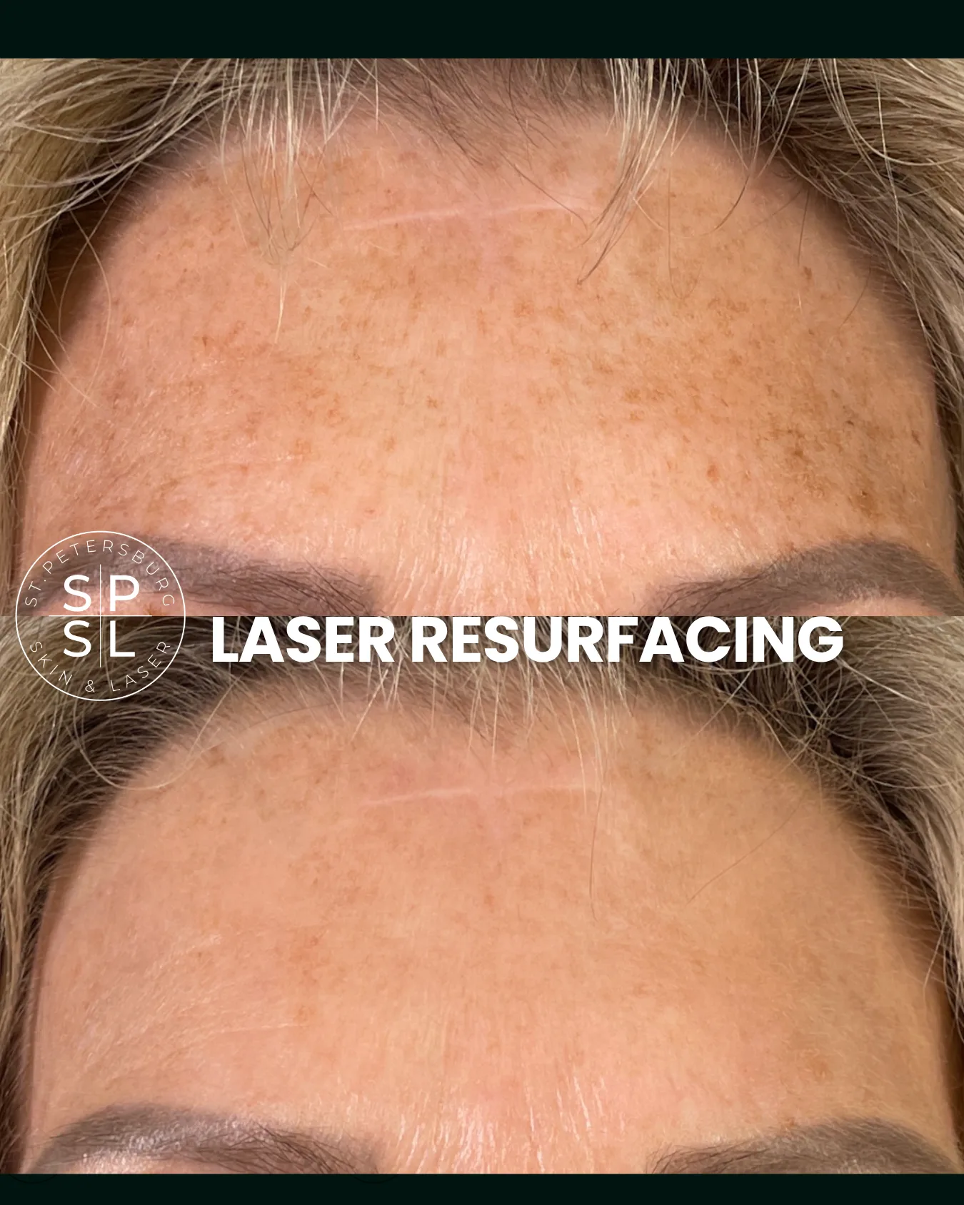 Laser Resurfacing before and after results
