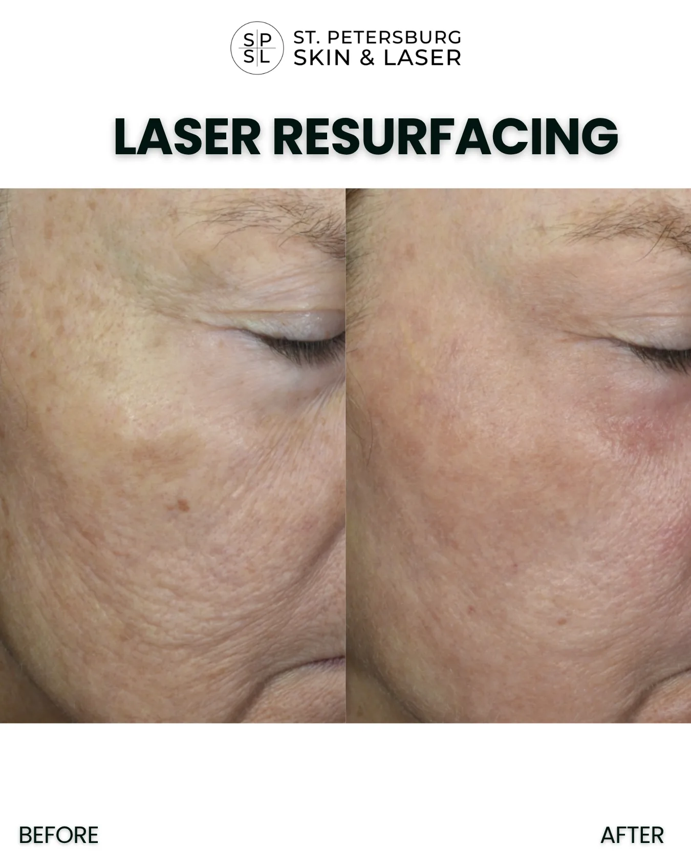 Laser Resurfacing before and after results
