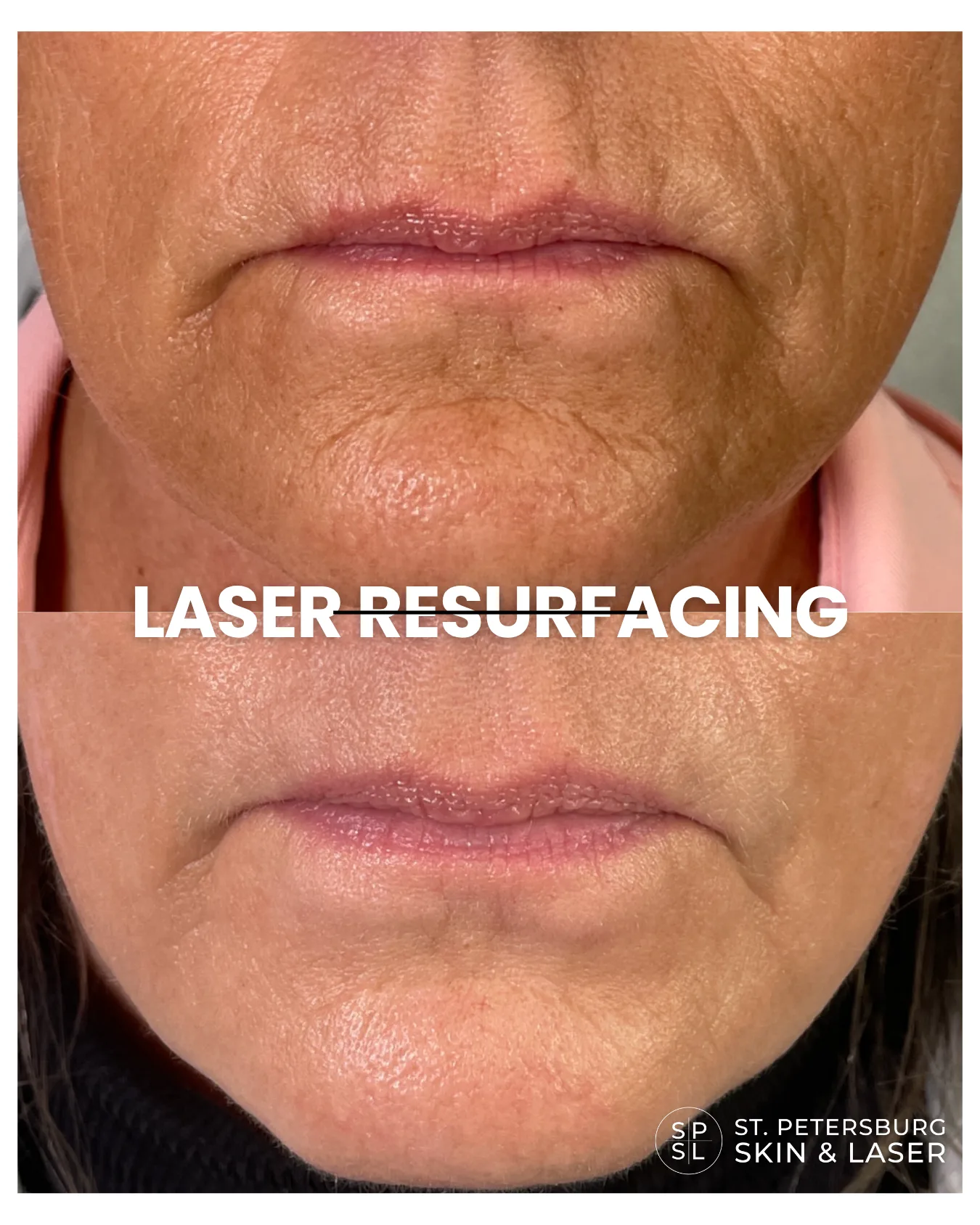Laser Resurfacing before and after results