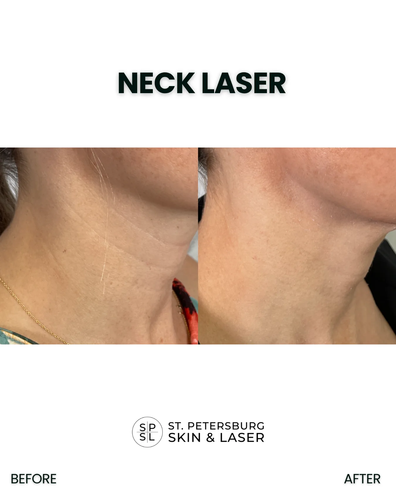 Neck and Chest Laser before and after results