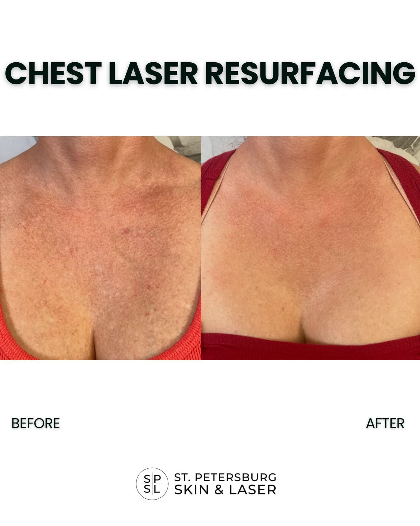 Neck and Chest Laser before and after results