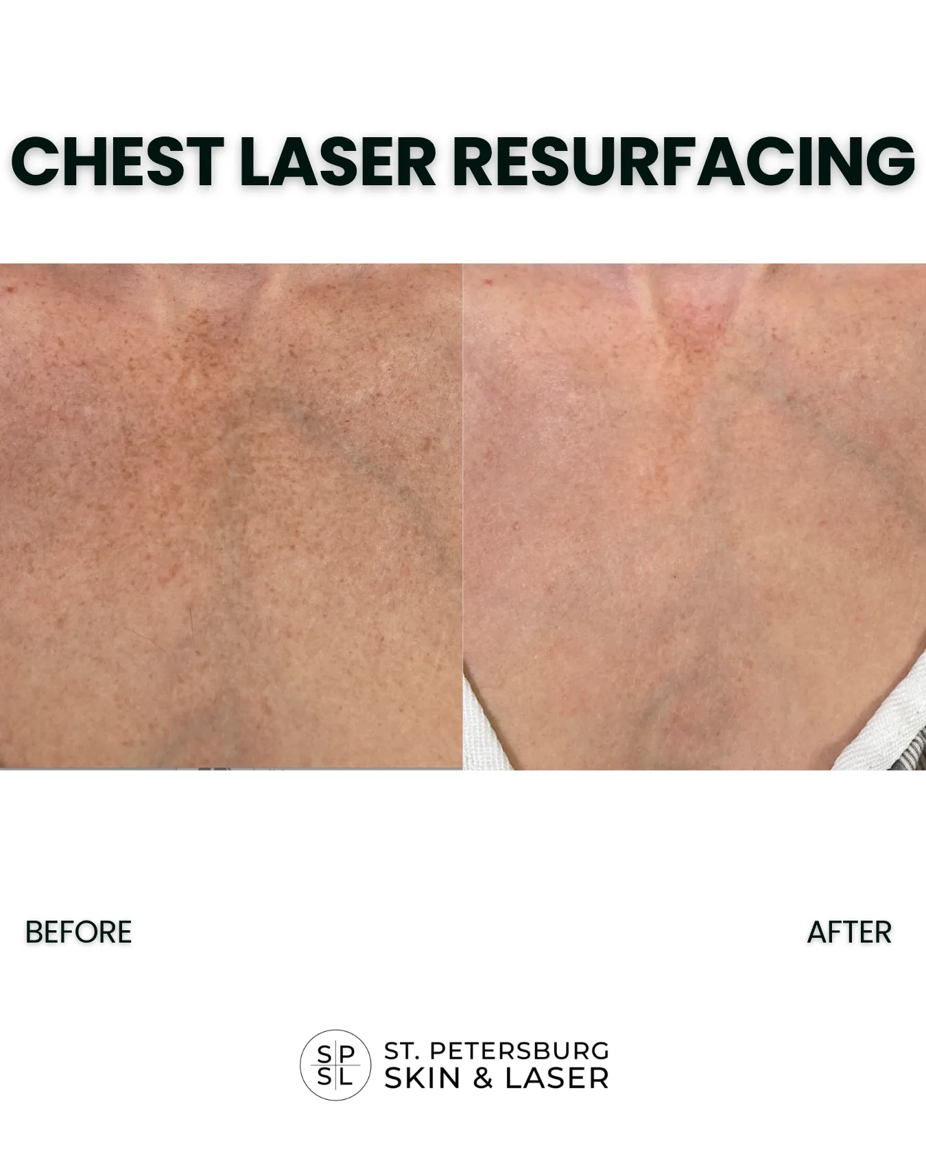 Neck and Chest Laser before and after results