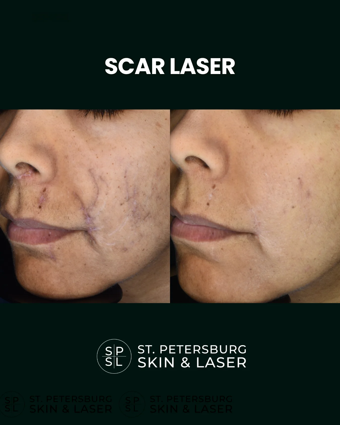Scar Laser before and after results