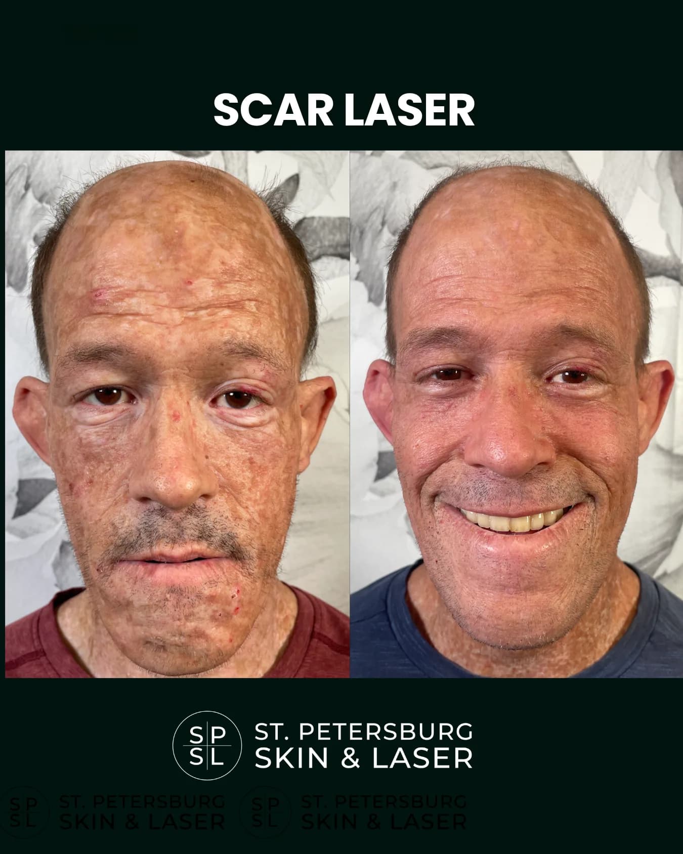Scar Laser before and after results