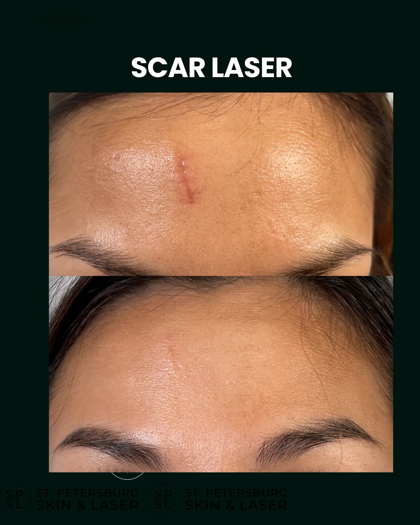 Scar Laser before and after results