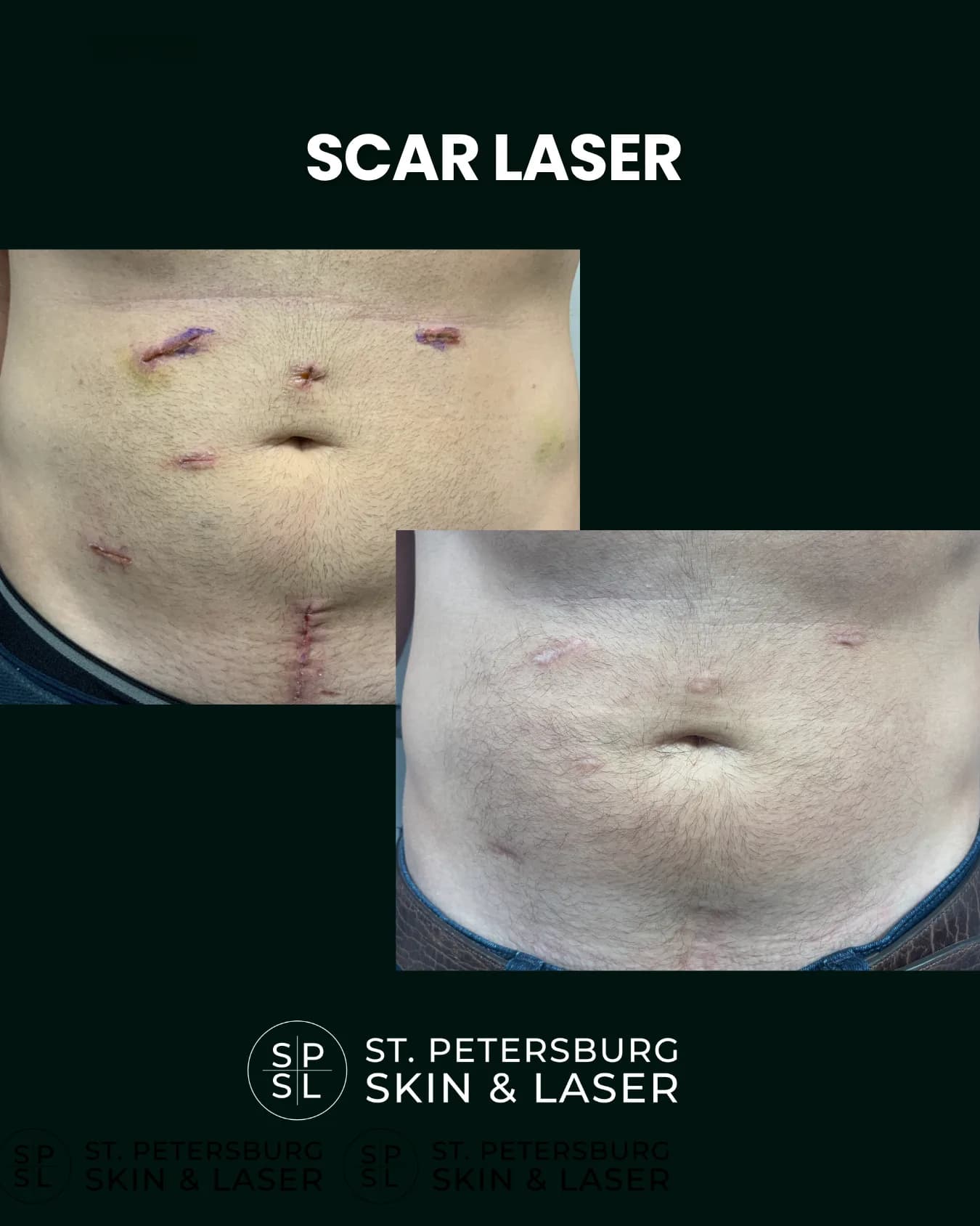 Scar Laser before and after results