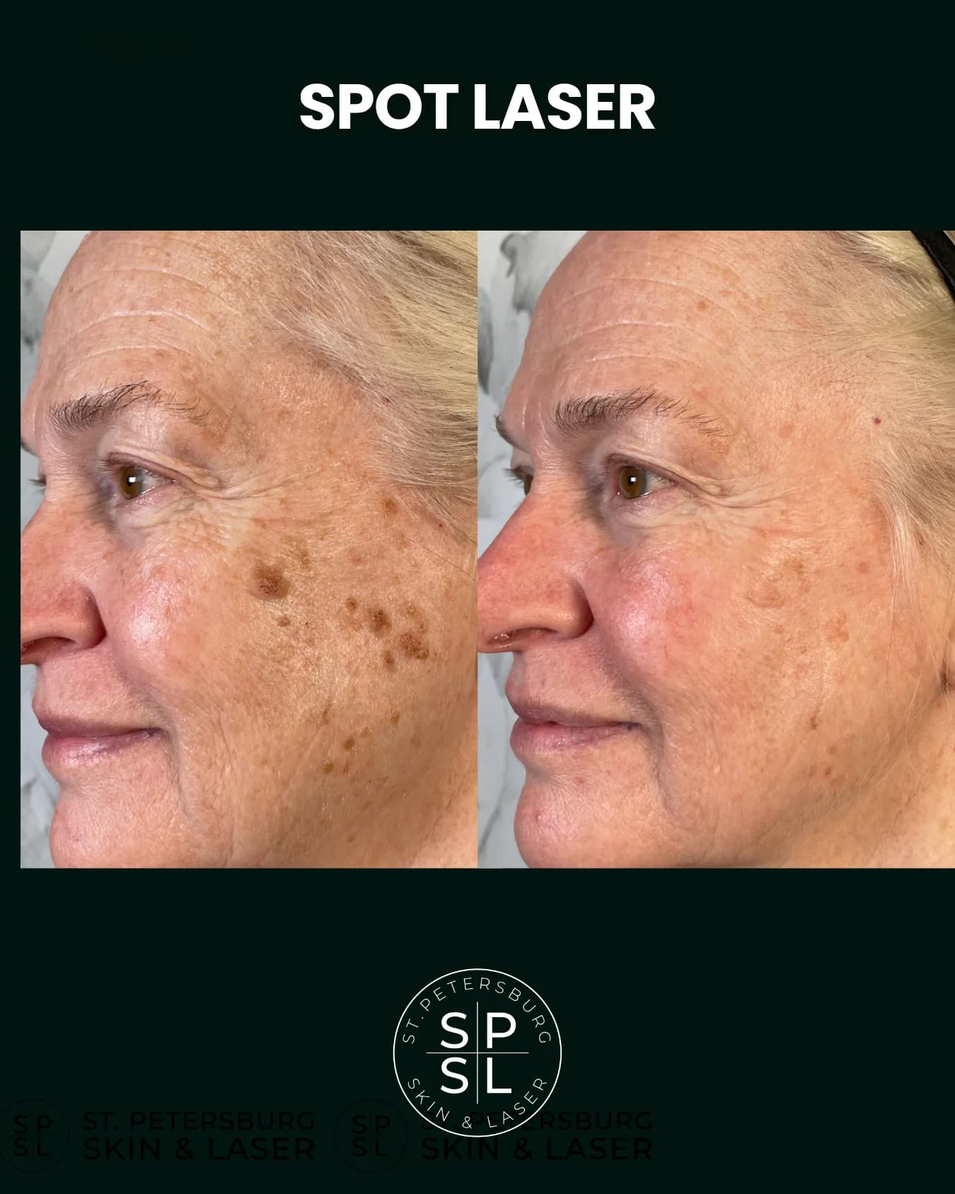 Spot Laser before and after results