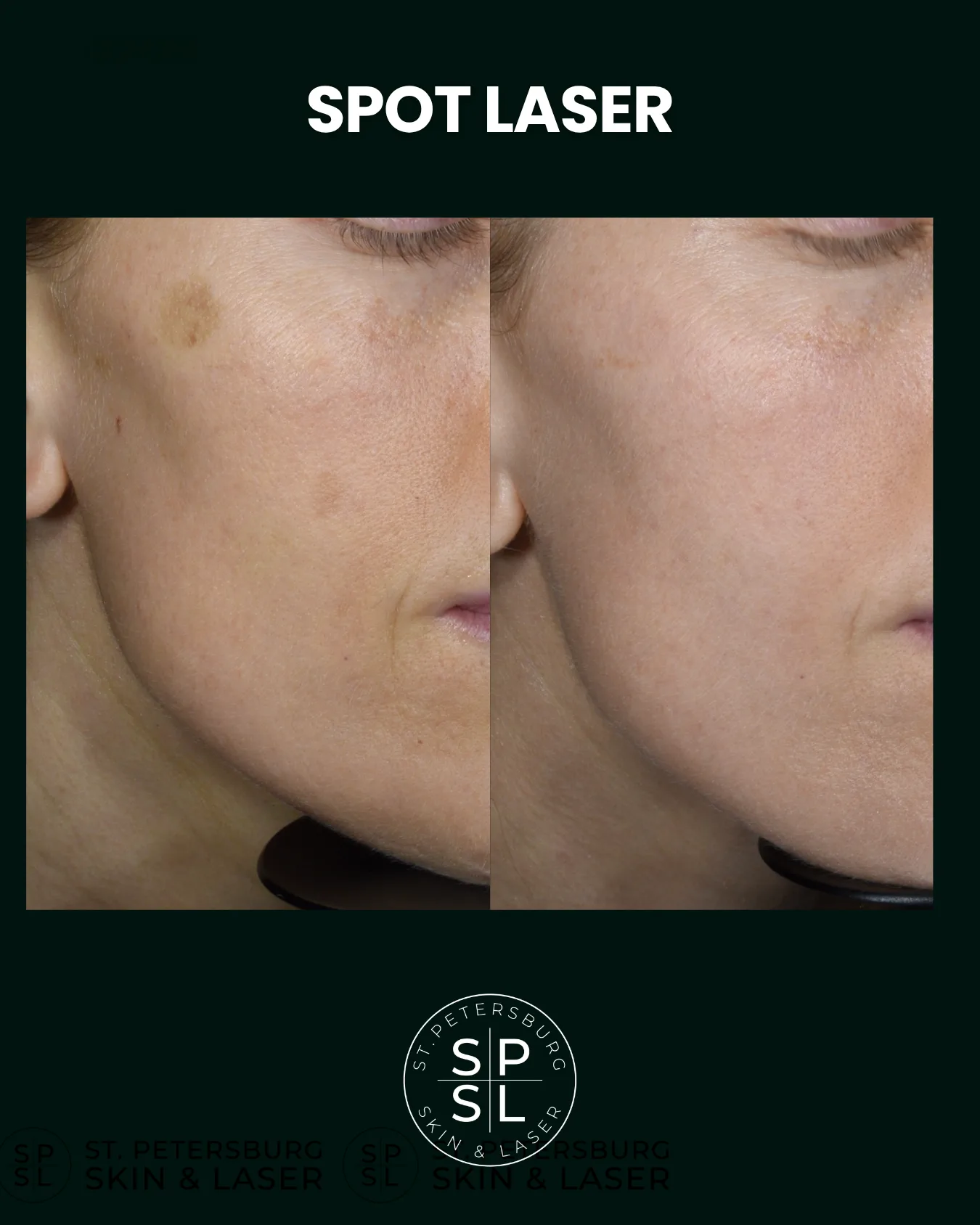 Spot Laser before and after results