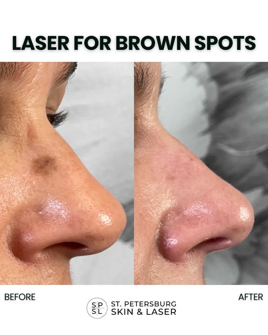 Before and after brown spot removal on the nose by Dr. Kat Kesty, St. Petersburg