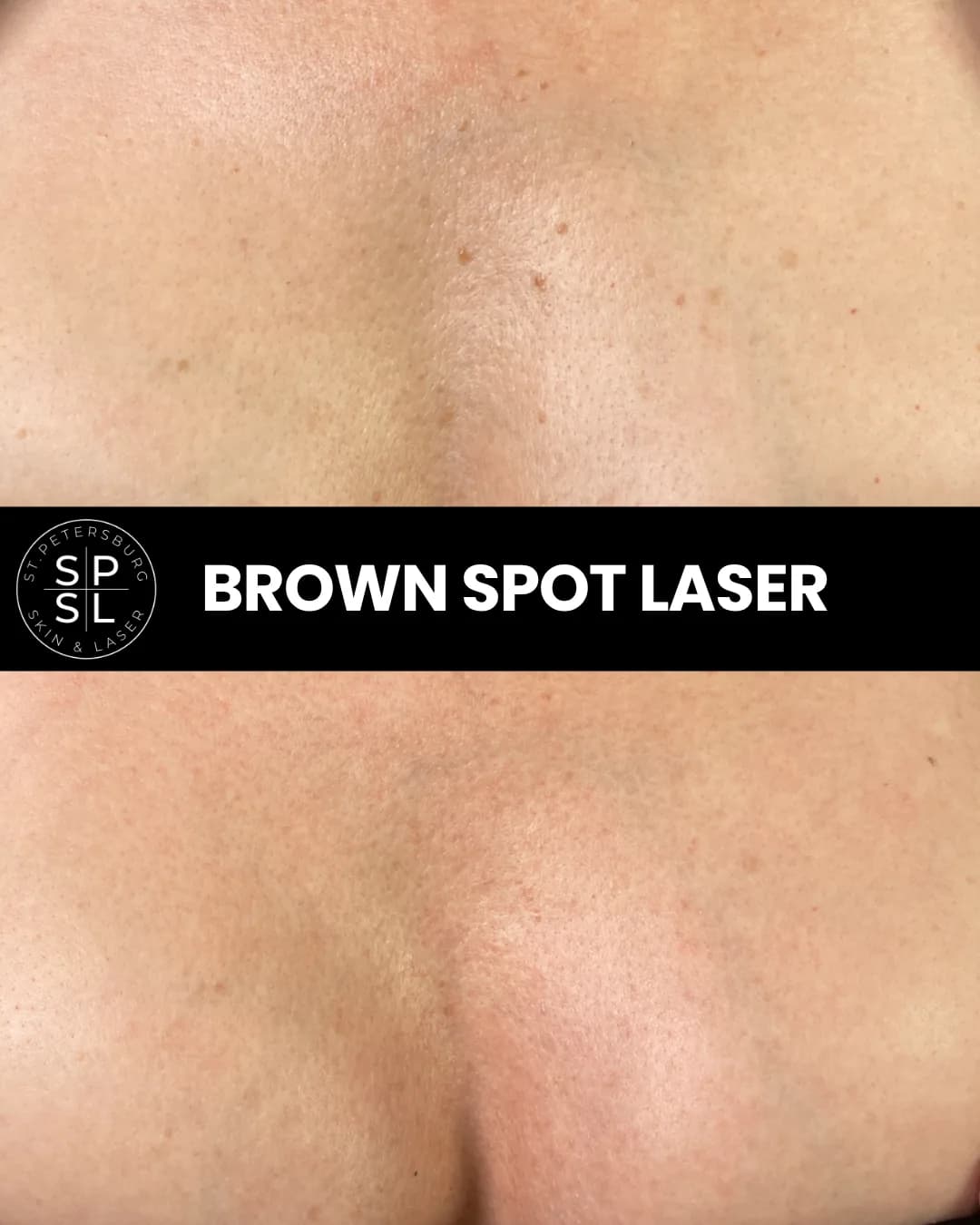 Before and after brown spot removal for sun spots on the chest by Dr. Kat Kesty