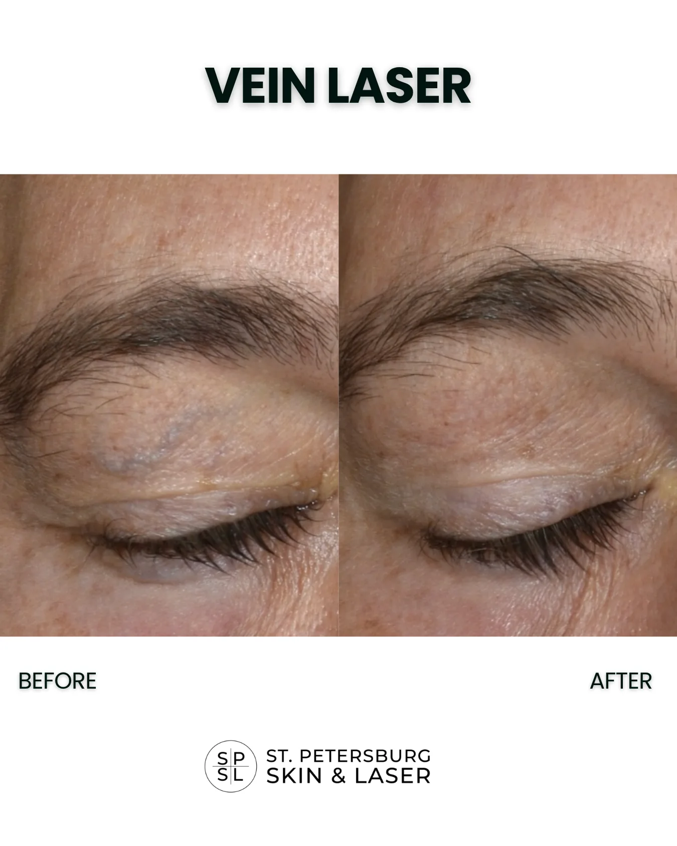 Vascular Laser before and after results
