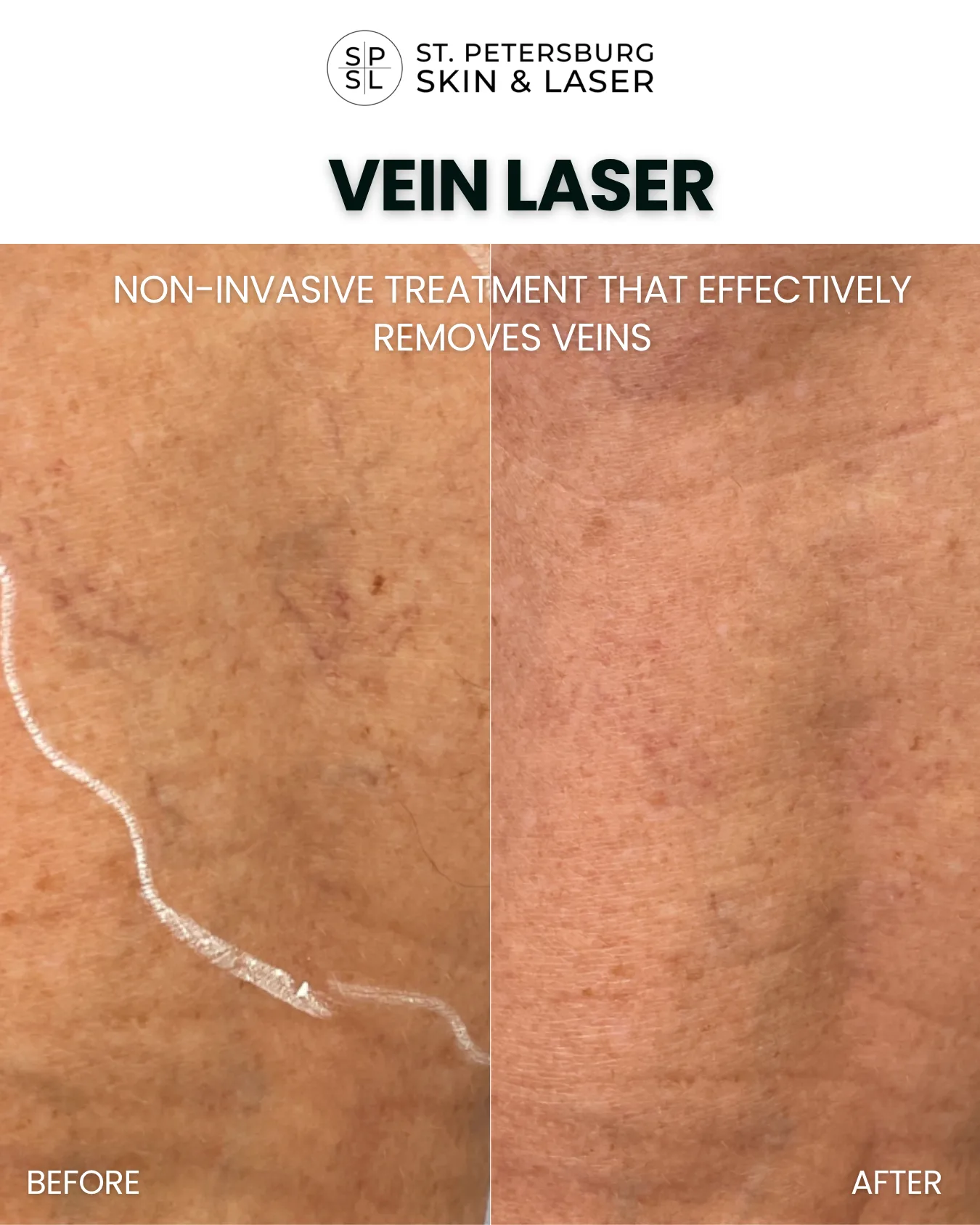 Vascular Laser before and after results