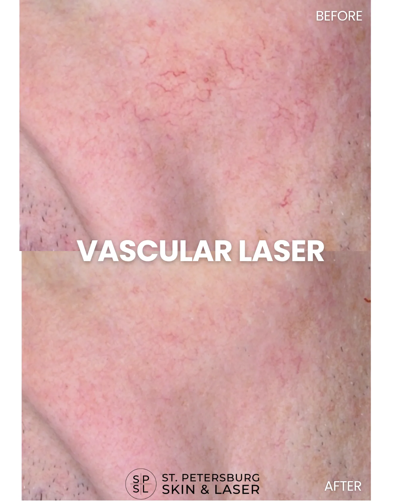 Vascular Laser before and after results