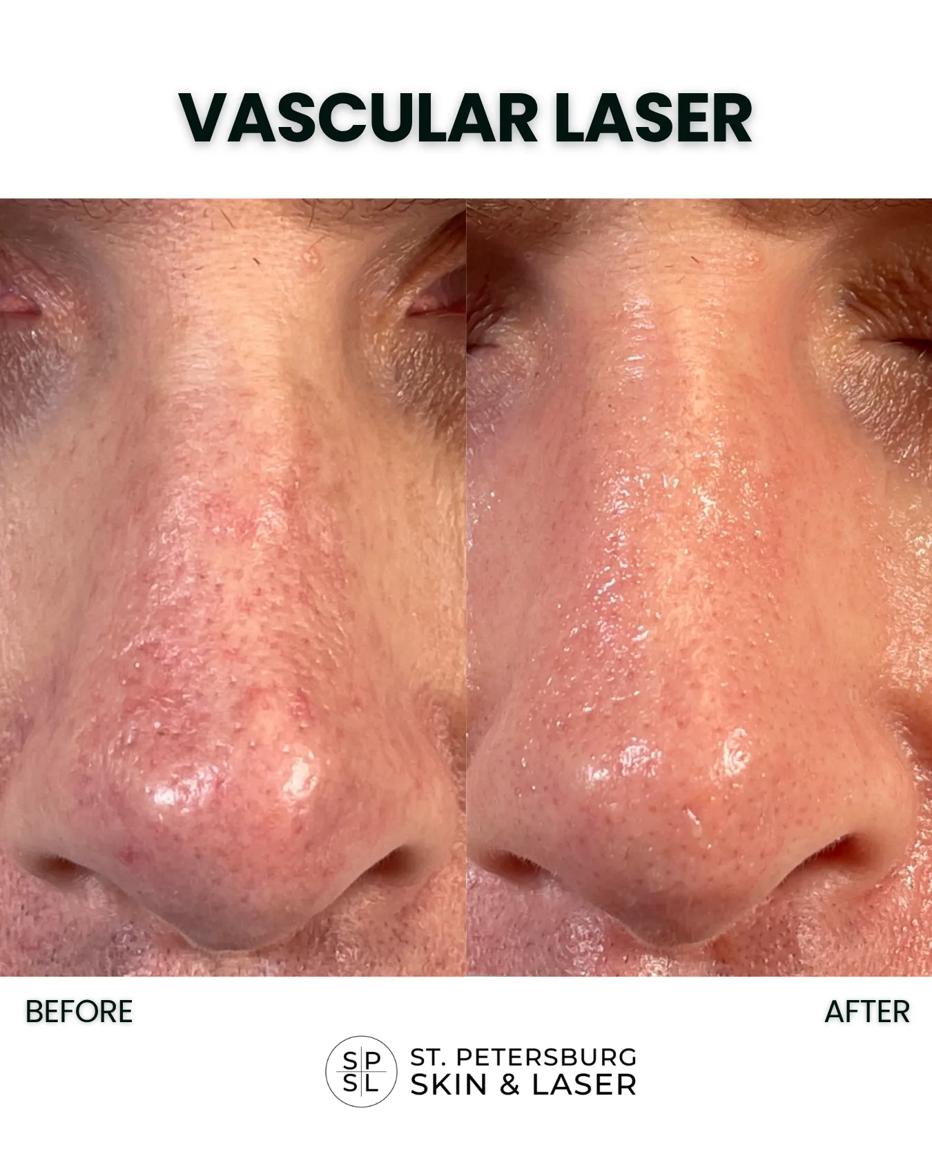 Vascular Laser before and after results