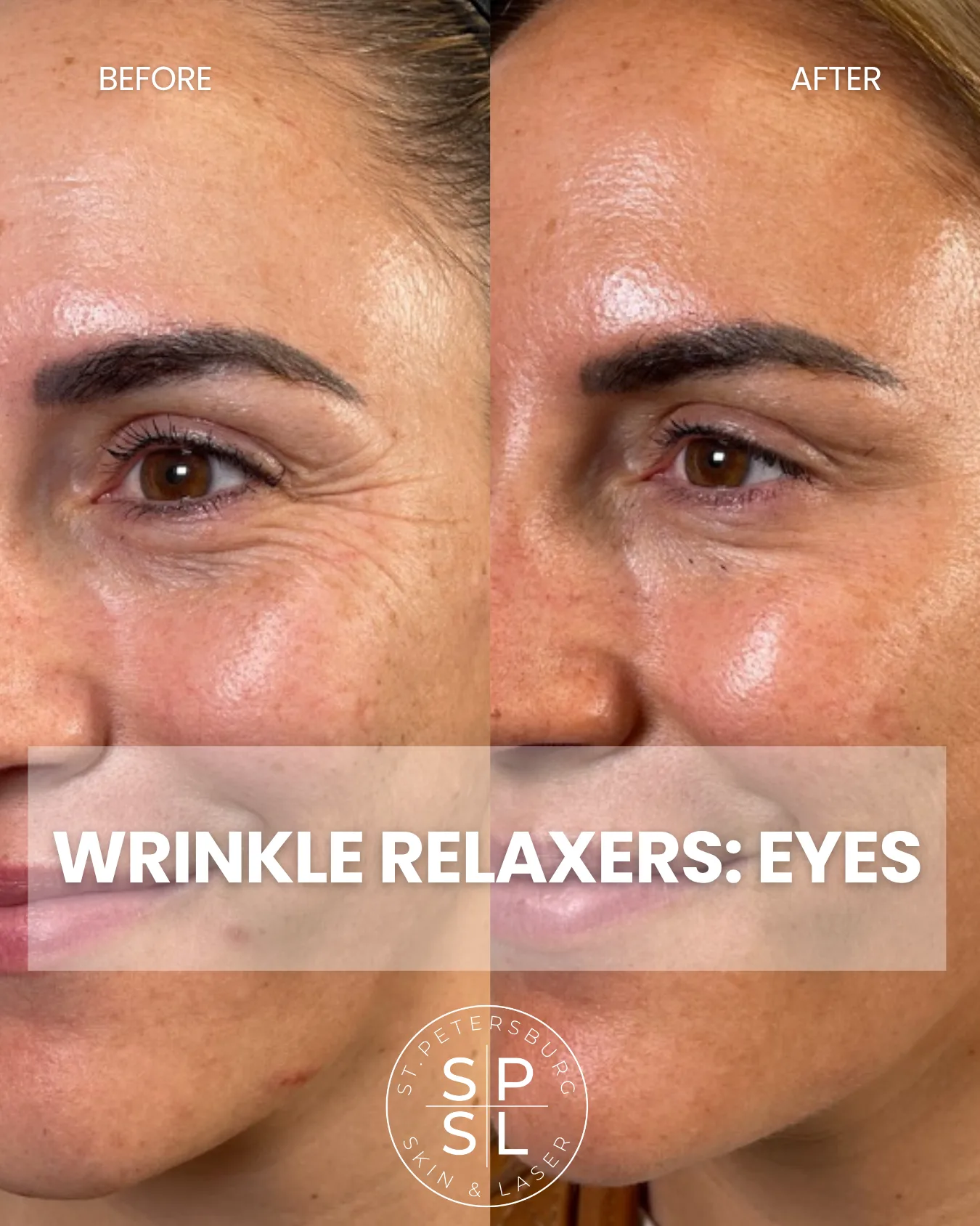 Wrinkle Relaxers before and after results