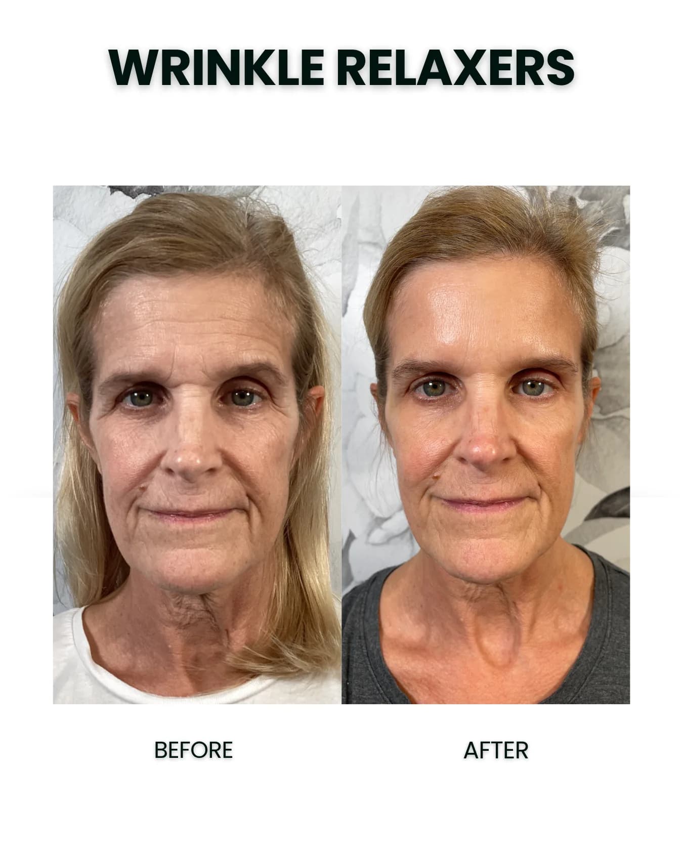 Wrinkle Relaxers before and after results