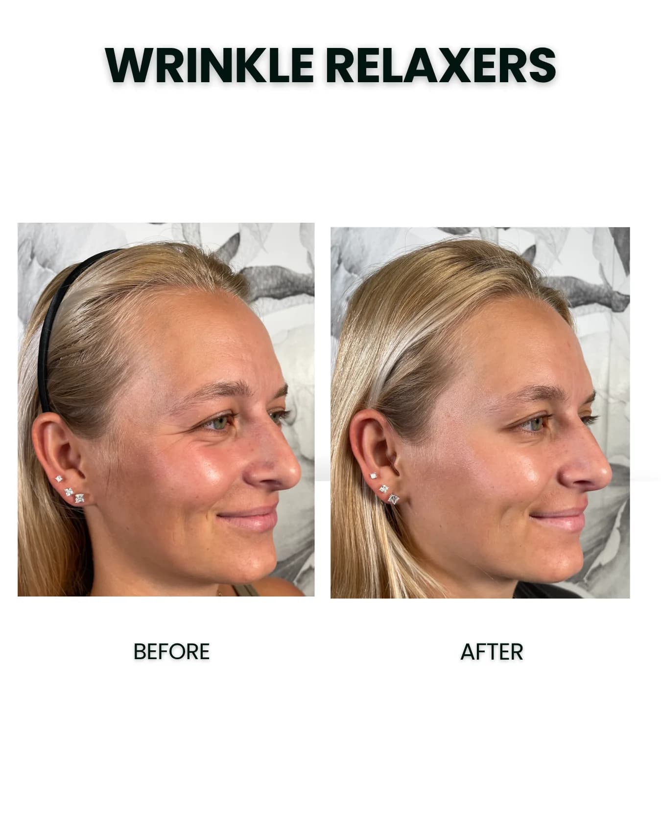 Wrinkle Relaxers before and after results