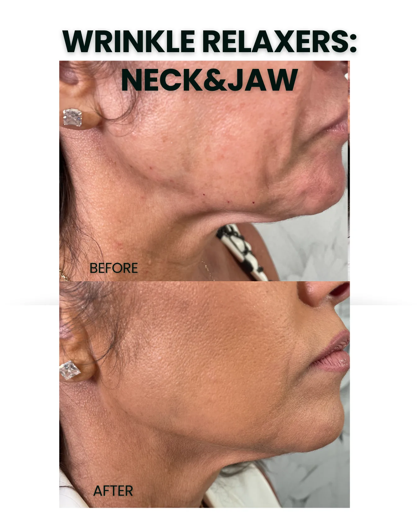 Wrinkle Relaxers before and after results