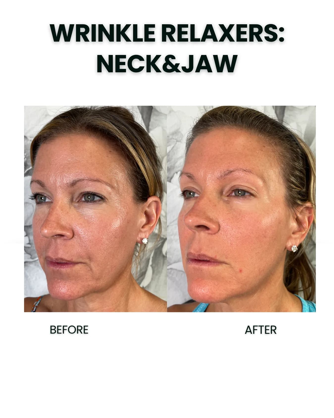 Wrinkle Relaxers before and after results
