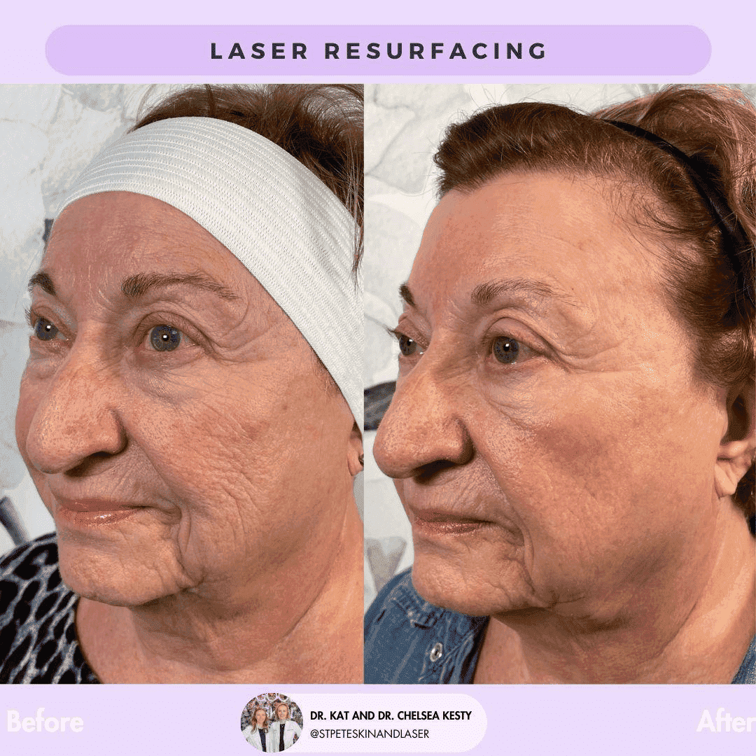 CO2 Laser Skin Resurfacing Before and After Results 2