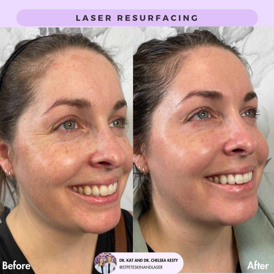 Advanced non-ablative laser technology