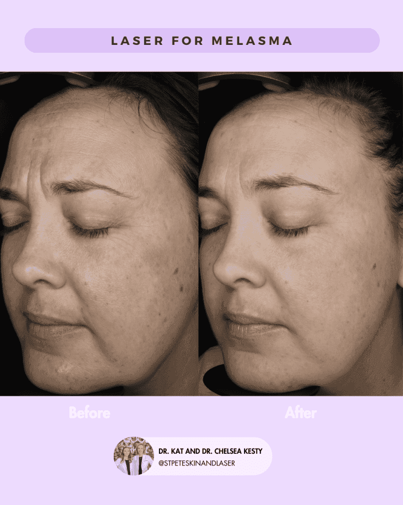 Other Cosmetic Procedures before and after results