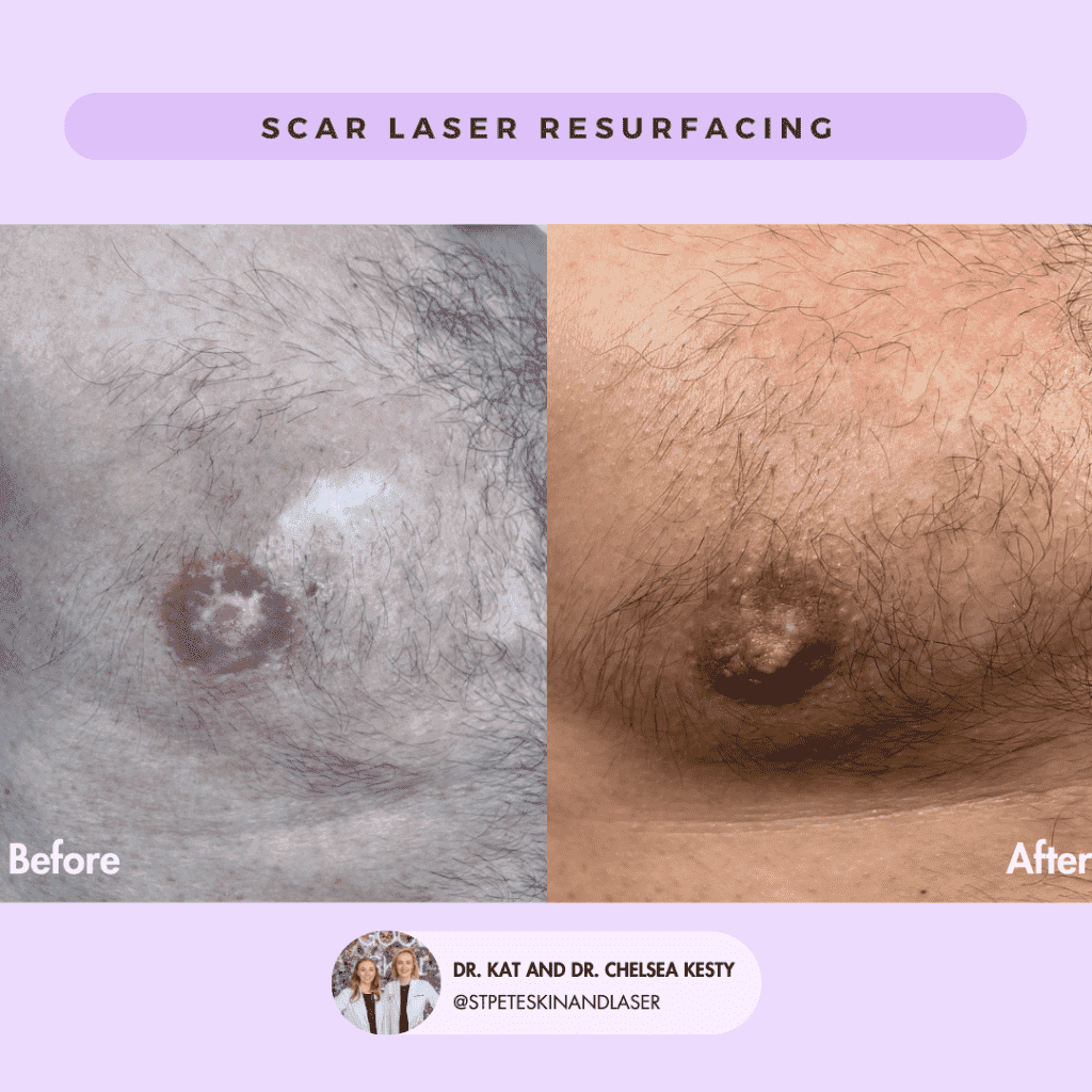 Laser Resurfacing before and after results