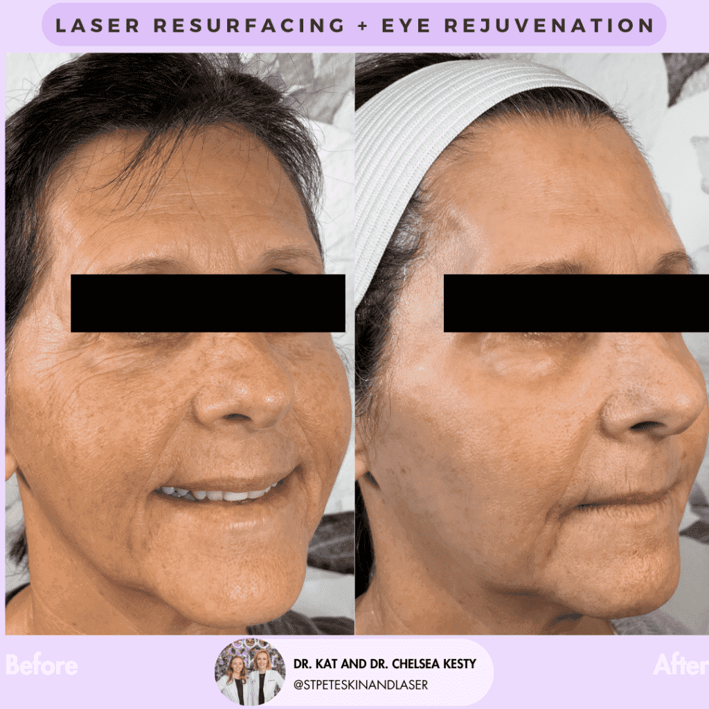 Laser Resurfacing before and after results