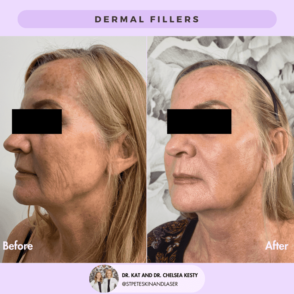 Dermal Fillers before and after results
