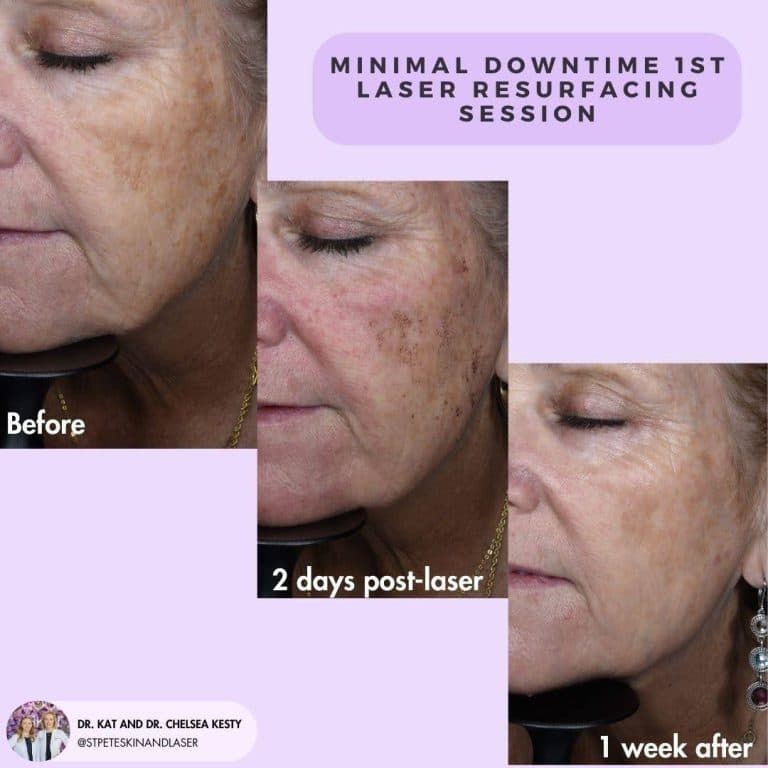 IPL and laser treatment comparison